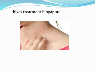 hives treatment Singapore
hives treatment singapore