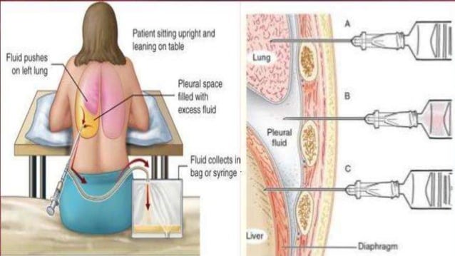 Procedure Practical - thoracentesis.pptx