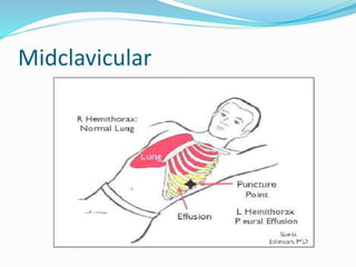 Midclavicular
 