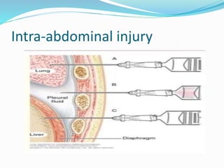 Intra-abdominal injury
 