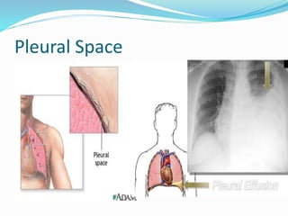 Pleural Space
 