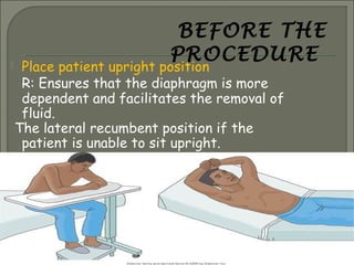 Thoracentesis