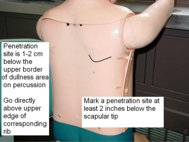 lungs from fluid drain how Thoracentesis lungs from fluid drain how Thoracentesis