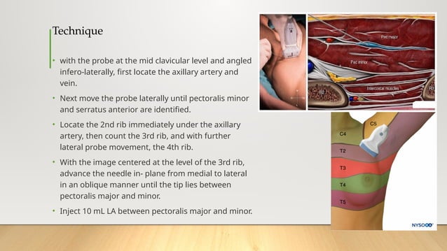 ANESTHESIA Thoracic & abdominal wall blocks.pptx