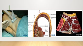 ANESTHESIA Thoracic & abdominal wall blocks.pptx