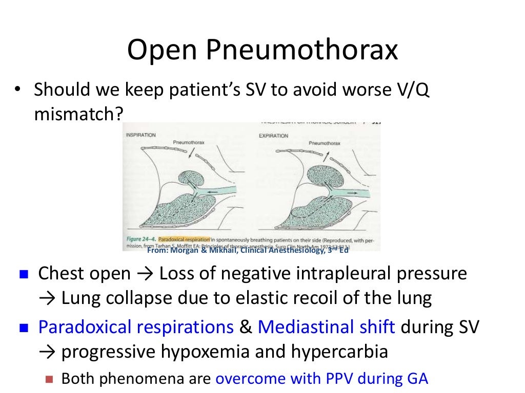 Thoracic anaesthesia One lung ventilation