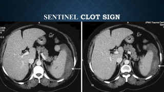 Sentinel Sign Radiology thoracic and abdominal trauma radiology finding | PPTX