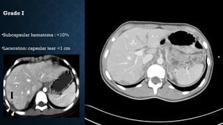 Grade I
•Subcapsular hematoma : <10%
•Laceration: capsular tear <1 cm
 