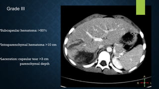 •Subcapsular hematoma: >50%
•Intraparenchymal hematoma >10 cm
•Laceration: capsular tear >3 cm
parenchymal depth
Grade III
 