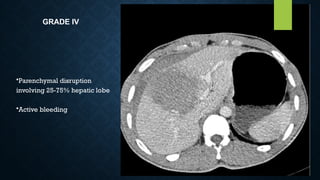 GRADE IV
•Parenchymal disruption
involving 25-75% hepatic lobe
•Active bleeding
 
