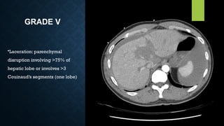GRADE V
•Laceration: parenchymal
disruption involving >75% of
hepatic lobe or involves >3
Couinaud’s segments (one lobe)
 