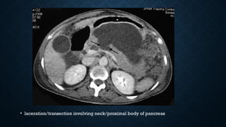 • laceration/transection involving neck/proximal body of pancreas
 