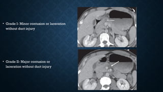 • Grade I- Minor contusion or laceration
without duct injury
• Grade II- Major contusion or
laceration without duct injury
 
