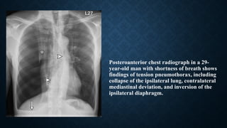 Posteroanterior chest radiograph in a 29-
year-old man with shortness of breath shows
findings of tension pneumothorax, including
collapse of the ipsilateral lung, contralateral
mediastinal deviation, and inversion of the
ipsilateral diaphragm.
 