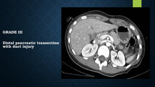 GRADE III
Distal pancreatic transection
with duct injury
 