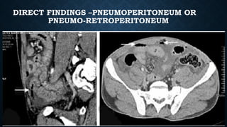 DIRECT FINDINGS –PNEUMOPERITONEUM OR
PNEUMO-RETROPERITONEUM
 