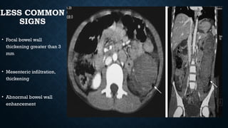 LESS COMMON
SIGNS
• Focal bowel wall
thickening greater than 3
mm
• Mesenteric infiltration,
thickening
• Abnormal bowel wall
enhancement
 