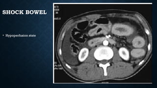 SHOCK BOWEL
• Hypoperfusion state
 