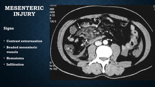 MESENTERIC
INJURY
Signs
• Contrast extravasation
• Beaded mesenteric
vessels
• Hematoma
• Infiltration
 