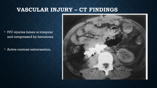 VASCULAR INJURY – CT FINDINGS
• IVC injuries lumen is irregular
and compressed by hematoma
• Active contrast extravasation.
 