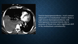 Tension haemopneumothorax. Axial contrast-
enhanced CT at mediastinal window shows a
right tension haemopneumothorax with
heterogeneous increased density due to
presence of blood clots and a significant shift
of the mediastinum contralaterally.
 