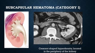 SUBCAPSULAR HEMATOMA (CATEGORY I)
Crescent shaped hyperdensity, located
in the periphery of the kidney
 
