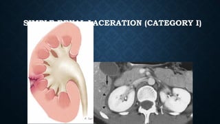 SIMPLE RENAL LACERATION (CATEGORY I)
 