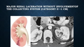 MAJOR RENAL LACERATION WITHOUT INVOLVEMENTOF
THE COLLECTING SYSTEM (CATEGORY II <1 CM)
 