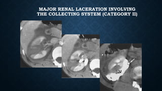 MAJOR RENAL LACERATION INVOLVING
THE COLLECTING SYSTEM (CATEGORY II)
 