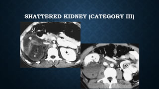 SHATTERED KIDNEY (CATEGORY III)
 
