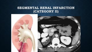 SEGMENTAL RENAL INFARCTION
(CATEGORY II)
 
