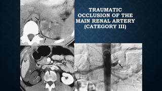 TRAUMATIC
OCCLUSION OF THE
MAIN RENAL ARTERY
(CATEGORY III)
 