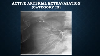 ACTIVE ARTERIAL EXTRAVASATION
(CATEGORY III)
 