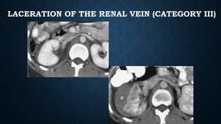 LACERATION OF THE RENAL VEIN (CATEGORY III)
 