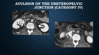 AVULSION OF THE URETEROPELVIC
JUNCTION (CATEGORY IV)
 