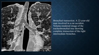 Bronchial transection. A 22-year-old
man involved in a car accident.
Volume-rendered image of the
tracheobronchial tree showing
complete transection of the right
intermediate bronchus.
 