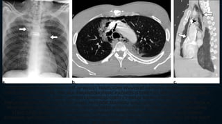 TRACHEAL INJURY IN A 32-YEAR-OLD MAN AFTER A THORACIC GUNSHOT WOUND. (A) AP RADIOGRAPH
SHOWS ENTRY AND EXIT SITES. THE AP BULLET TRAJECTORY WOULD BE EXPECTED TO INVOLVE MIDLINE
STRUCTURES SUCH AS THE TRACHEA. PARAMEDIASTINAL HAZINESS IS DEPICTED, REFLECTING PULMONARY
CONTUSIONS. (B) AXIAL CONTRAST-ENHANCED CHEST CT IMAGE SHOWS EXTENSIVE DIFFUSE
PNEUMOMEDIASTINUM. NOTE THE SMALL ANTERIOR TRACHEAL WALL DEFECT. TRACHEAL INJURY FROM A
PENETRATING WOUND WOULD LIKELY BE ASSOCIATED WITH INJURY TO OTHER ADJACENT MEDIASTINAL
STRUCTURES AS WELL. (C) PARASAGITTAL CONTRAST-ENHANCED REFORMATTED CT IMAGE SHOWS
EXTENSIVE ANTERIOR AND POSTERIOR PNEUMOMEDIASTINUM FROM THE VISUALIZED NECK TO THE ROOT
 