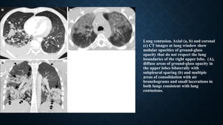 Lung contusion. Axial (a, b) and coronal
(c) CT images at lung window show
nodular opacities of ground-glass
opacity that do not respect the lung
boundaries of the right upper lobe. (A),
diffuse areas of ground-glass opacity in
the upper lobes bilaterally with
subpleural sparing (b) and multiple
areas of consolidation with air
bronchograms and small lacerations in
both lungs consistent with lung
contusions.
 