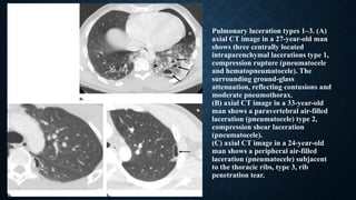 Pulmonary laceration types 1–3. (A)
axial CT image in a 27-year-old man
shows three centrally located
intraparenchymal lacerations type 1,
compression rupture (pneumatocele
and hematopneumatocele). The
surrounding ground-glass
attenuation, reflecting contusions and
moderate pneumothorax.
(B) axial CT image in a 33-year-old
man shows a paravertebral air-filled
laceration (pneumatocele) type 2,
compression shear laceration
(pneumatocele).
(C) axial CT image in a 24-year-old
man shows a peripheral air-filled
laceration (pneumatocele) subjacent
to the thoracic ribs, type 3, rib
penetration tear.
 