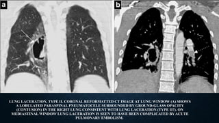 LUNG LACERATION, TYPE II. CORONAL REFORMATTED CT IMAGE AT LUNG WINDOW (A) SHOWS
A LOBULATED PARASPINAL PNEUMATOCELE SURROUNDED BY GROUND-GLASS OPACITY
(CONTUSION) IN THE RIGHT LUNG CONSISTENT WITH LUNG LACERATION (TYPE II?). ON
MEDIASTINAL WINDOW LUNG LACERATION IS SEEN TO HAVE BEEN COMPLICATED BY ACUTE
PULMONARY EMBOLISM.
 