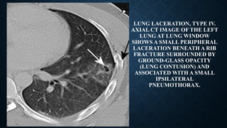 LUNG LACERATION, TYPE IV.
AXIAL CT IMAGE OF THE LEFT
LUNG AT LUNG WINDOW
SHOWS A SMALL PERIPHERAL
LACERATION BENEATH A RIB
FRACTURE SURROUNDED BY
GROUND-GLASS OPACITY
(LUNG CONTUSION) AND
ASSOCIATED WITH A SMALL
IPSILATERAL
PNEUMOTHORAX.
 