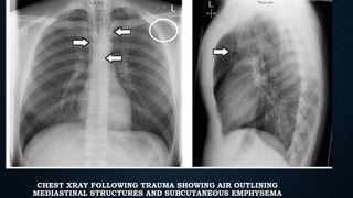 CHEST XRAY FOLLOWING TRAUMA SHOWING AIR OUTLINING
MEDIASTINAL STRUCTURES AND SUBCUTANEOUS EMPHYSEMA
 