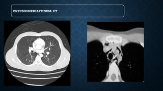 PNEUMOMEDIASTINUM: CT
 