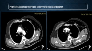 PNEUMOMEDIASTINUMWITH SUBCUTANEOUS EMPHYSEMA
 