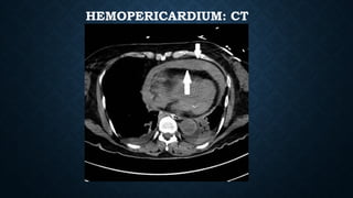 HEMOPERICARDIUM: CT
 