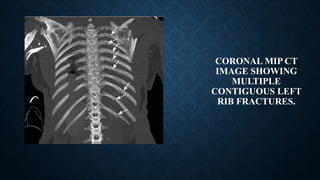 CORONAL MIP CT
IMAGE SHOWING
MULTIPLE
CONTIGUOUS LEFT
RIB FRACTURES.
 