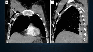 CORONAL (A) AND SAGITTAL (B) RECONSTRUCTED CT IMAGES SHOW
FRACTURES OF THREE CONTIGUOUS RIGHT RIBS (ARROWS) THAT WERE
ASSOCIATED WITH PARADOX MOTION OF THE CHEST DURING RESPIRATION.
 