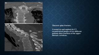 Thoracic spine fracture.
Coronal (a) and sagittal (b) CT
reconstructed images of two different
patients show fractures of the upper
thoracic vertebrae.
 
