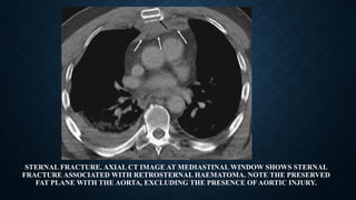 STERNAL FRACTURE. AXIAL CT IMAGE AT MEDIASTINAL WINDOW SHOWS STERNAL
FRACTURE ASSOCIATED WITH RETROSTERNAL HAEMATOMA. NOTE THE PRESERVED
FAT PLANE WITH THE AORTA, EXCLUDING THE PRESENCE OF AORTIC INJURY.
 