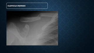 CLAVICLE INJURIES
 